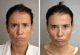 Es importante seguir una serie de consejos antes de comenzar un tratamiento de bótox en la cara: Toxina Botulinica O Botox En Barcelona Opcion Medica