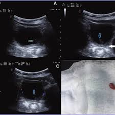 Merter Keceli Medical Doctor Doctor Of Medicine Pediatric Radiology