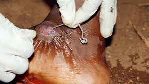 The american society of tropical medicine and hygiene. Drakunkulose Deximed