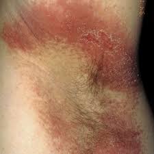 I have noticed over a week i had an infected hair in my armpit, there was like i tried to open it up but only got blood, and now when i lift my arm up there is a vein that is very noticeable when my arm is up. Common Rashes Found In The Armpits