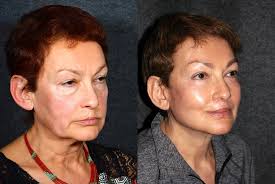 23 FACELIFTS ideas