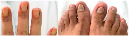 Image result for Yellow nail syndrome feet