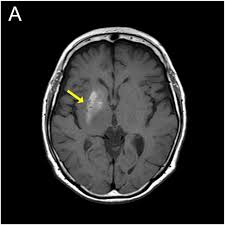 Image result for Chorea