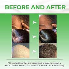 Unwanted or unusual hair growth is often caused by the increased production of androgens there are several topical products on the market that claim to stop or slow down hair growth. Biotin Hair Growth Serum Advanced Topical Formula To Help Grow Healthy Strong Hair Suitable For Men And Women Of All Hair Types Hair Loss Support By Pureauty Naturals Pricepulse