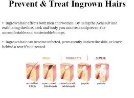 All you have to do is put a few drops of tea tree essential oil onto the end of a cotton swab and apply directly to the ingrown hair. For More Information On Our Acne Kit Or Shaving To Prevent Ingrown Hairs Visit Our Website For Personalized Acne Kits Treat Ingrown Hair Pimples Under The Skin