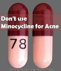 Don T Use Minocycline For Acne Acne Minocycline Acne Skin Care Acne Acne Cream