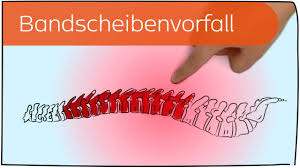 Bandscheibenvorfall In 3 Minuten Erklart Youtube