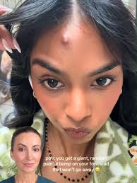 🙌 This is how it’s DONE. As a board-certified derm, I see way too many  cyst horror stories online — people picking, popping, and applying  who-knows-what, only to end up with scars or infections. This ...