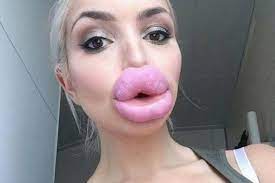 Terrifying Pictures Show Worrying Trend Of Porn Star Lip Fillers Mirror Online
