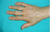 În majoritatea cazurilor, cancerul de sân este descoperit prin observarea unui nodul. Probleme La San Nodulii Boli Si Tratamente