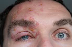 Image result for herpes zoster