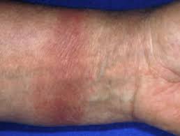 Being allergic to other types of metal, as well as having a family history. Contact Allergy To Gold Dermnet Nz