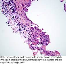Gallbladder is a hollow, pear shaped organs of digestive system of body. Pathology Outlines Mesothelial