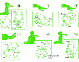 Image result for Canalith Repositioning Procedure