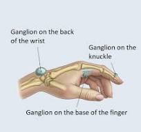Ganglion removal - Medicover