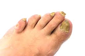 Emuaid was a life saver. 9 Natural Ways To Treat Toenail Fungus At Home Onychomycosis Help