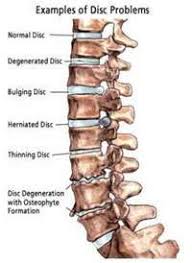 Check Out Our Inversion Tables Inversion Therapy Can Help With Overall Back Health Reduce Muscle Pai Degenerative Disc Degenerative Disc Disease Spine Health