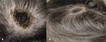 Necrosis (from ancient greek νέκρωσις, nékrōsis, death) is a form of cell injury which results in the premature death of cells in living tissue by autolysis. Scalp Necrosis In Giant Cell Arteritis Mayo Clinic Proceedings