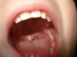 Mandelentzundung Angina Tonsillaris Tonsillitis Ursachen Beschwerden Diagnose Behandlung Prognose Vorbeugung Gesundmed Medizin Und Gesundheit Im Web