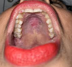 Image result for Erythroplakia roof of mouth