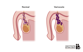 Image result for Varicocele