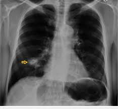 Chest X Ray Showing Right Middle Lobe Opacity Arrow Download Scientific Diagram