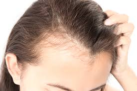 If your hairloss is related to the autoimmune reaction from celiac you simply can't cheat on the diet. Frontal Fibrosing Alopecia In Women Linked To Autoimmune Disease Thyroid Abnormalities Dermatology Advisor
