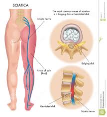 Neuralgia Ilustracoes Vetores E Clipart De Stock 766 Stock Illustrations