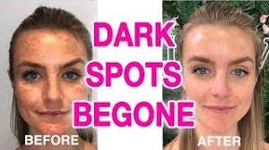 2 of 8 skinceuticals c e ferulic. The Ultimate Dark Spot Remover Guide Youtube