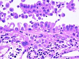 Panel a shows plasma fibulin3 levels in patients with malignant pleural mesothelioma as compared with all other cohorts. Pathology Walker Auto Tweet Bot On Twitter Malignant Mesothelioma Epithelioid Type Peritoneum Biopsy Pathology