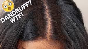 Get Rid Of Dandruff Instantly In Just One Wash Youtube