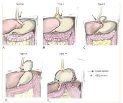 Image result for Hernia Reduction
