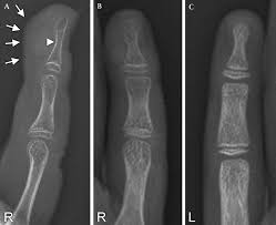 Image result for Glomus tumor