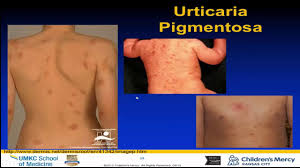 Image result for Exercise-Induced Anaphylaxis