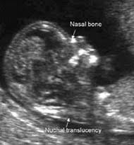 nuchal scan first trimester screening results normal