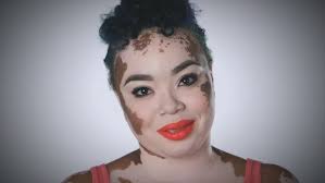 World Vitiligo Day