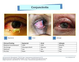 Image result for Conjunctivitis