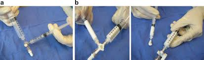 Nausea, vomiting, mucosal lesions, esophageal perforation, discoloration at the site of injection, ulceration at the site. Sclerotherapy Thoracic Key