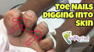 This can effectively change the overall course of nail growth, causing it to grow in an unfavorable direction. Nails Curling Into Toes Nail Trimming For Diabetic Ingrown Nails At The Ends Of The Toe Youtube