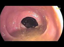 Image result for small intestine horrible