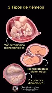 En obstetricia, la clasificación de los embarazos gemelares y sus riesgos  depende principalmente de la cigosidad (si son monocigóticos o dicigóticos)  y de la corionicidad/amniocidad (compartir o no ...