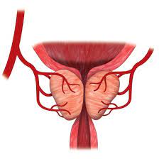 Explains prostate problems including prostatitis and benign prostatic hyperplasia. Universitatsklinikum Regensburg Prostata Arterien Embolisation Pae