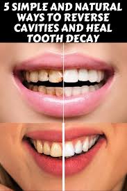 Check spelling or type a new query. How To Heal Cavities And Tooth Decay Naturally Arxiusarquitectura