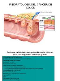 Nu uitati ca dincolo de leacurile batranesti alimentaţia reprezinta un factor frecvent incriminat pentru apariţia dilataţiilor venoase de la nivelul anusului. Cancer De Colon Fisiopatologia Sucul De SfeclÄ Rosie Beneficii Miraculoase Pentru Organism Suc Natural Sfecla Rosie