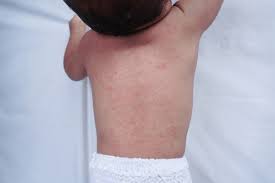 Image result for sweat rash on back baby