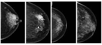 Invasive breast cancer can appear as a white patch or mass on a mammogram. Ai Rivals Human Radiologists At Breast Cancer Detection Physics World