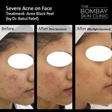 Please enter your address, city, state or zip code, so that we can display the businesses near you. Skin Specialist In Mumbai The Bombay Skin Clinic Dr Batul Patel