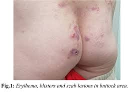 Diffuse Genital Herpes