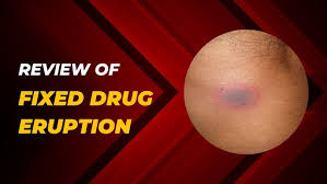 Image result for Fixed Drug Eruption