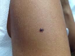 If you see anything new, changing or unusual on your skin, go get checked by a dermatologist. I Blame Myself For Getting Skin Cancer